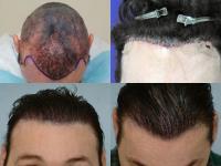 ForHair Hair Transplant Clinic image 47